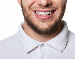 a man smiling with a missing tooth