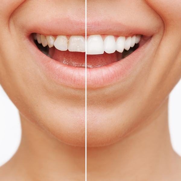 Woman's smile before and after veneers