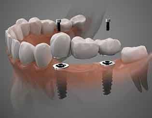 Illustration of dental implant bridge in Pinehurst, NC