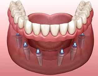 Illustration of implant denture in Pinehurst, NC