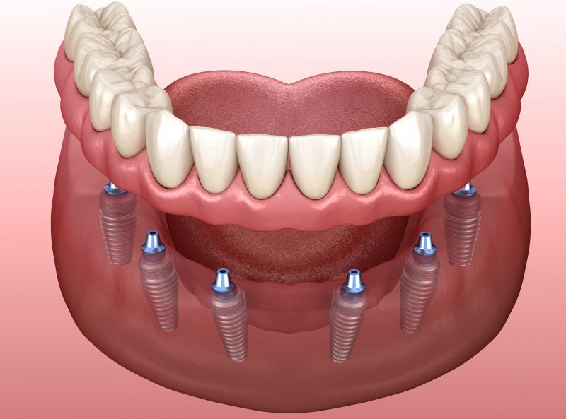 Illustration of implant denture